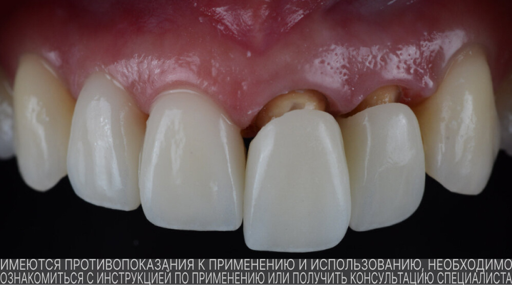 Обточенные зубы с незафиксированными ортопедическими конструкциями