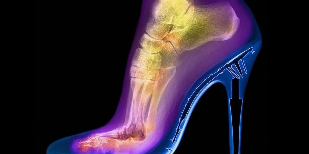 Последствия невропатии подошвенных нервов: осложнения, основные причины и симптомы болезни