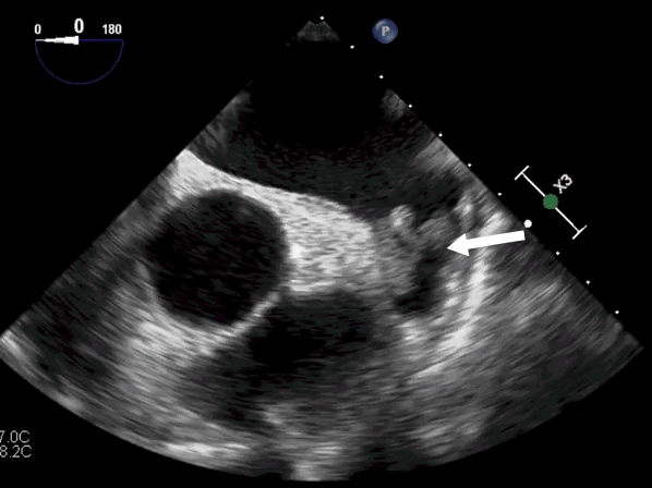 Тромбы в ушке левого предсердия. Стрелка указывает на тромбы.
Источник: https://edu.euat.ru/study/view?id=283