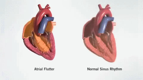 Слева изображена фибрилляция предсердий, справа - нормальный синусовый ритм