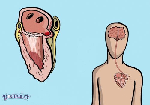 Обратите внимание, как тромб из ушка левого предсердия попадает в левый желудочек и дальше идет по сосудам в головной мозг.
Источник: https://doctablet.com/
