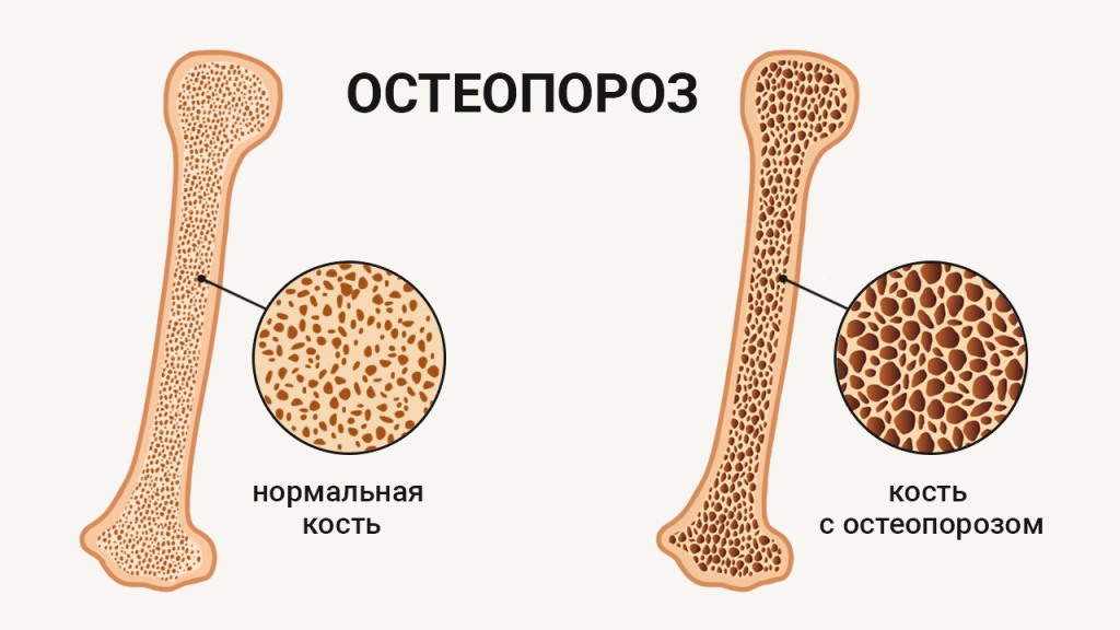 Остеопороз болят кости. Остеопороз рисунок. Профилактика остеопороза картинки.