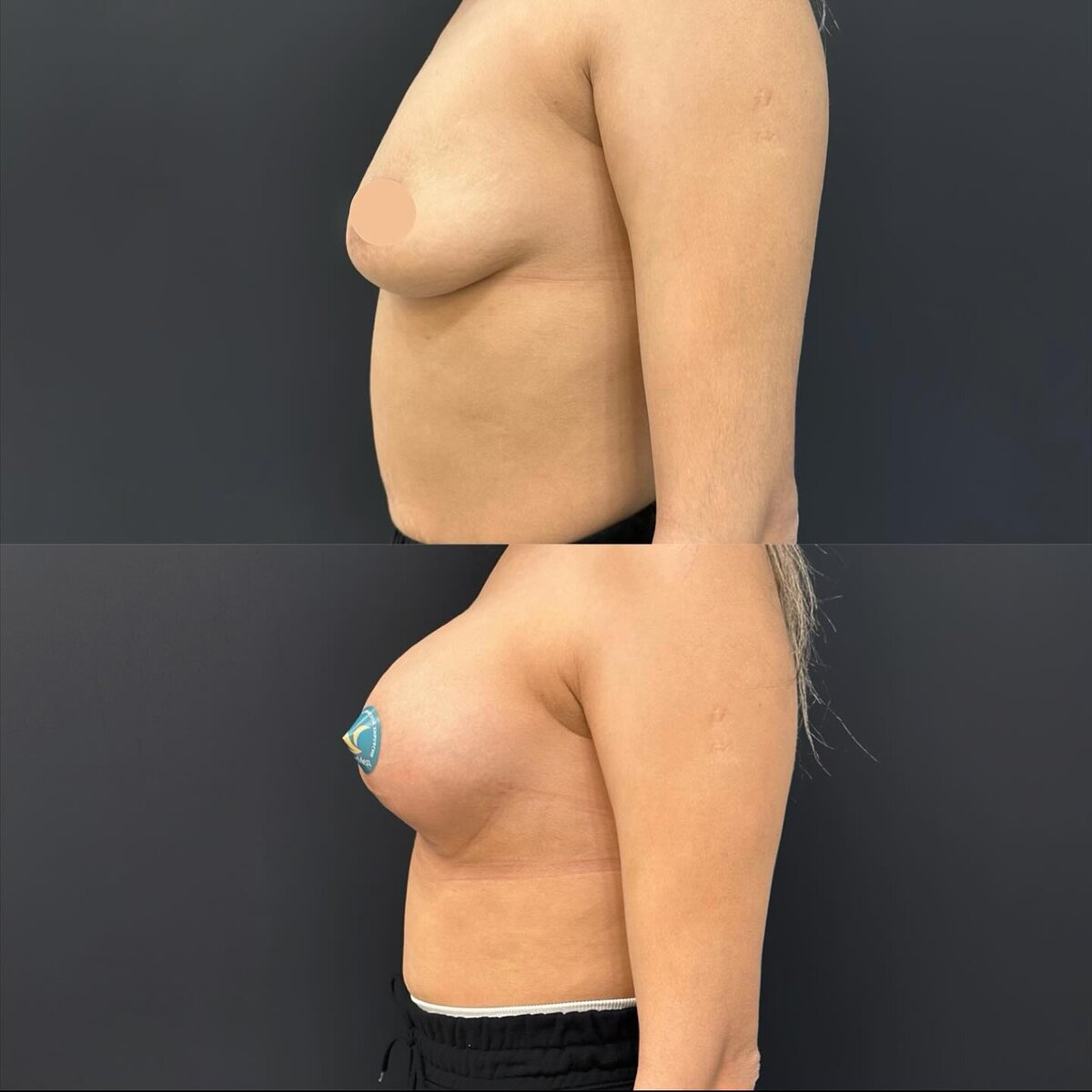 Результат увеличения груди с подтяжкой спустя 1,5 месяца. Круглые импланты Silimed. Объем 355 мл. Пластический хирург Атаманов Дмитрий Константинович