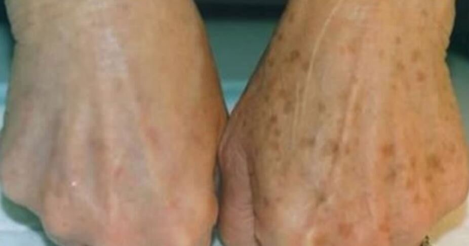 Пигментные пятна - это форма гиперпигментации.