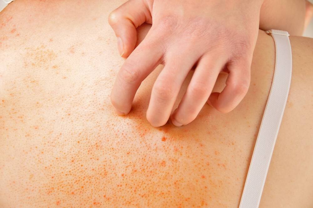 Некоторые пятна на коже становятся темнее