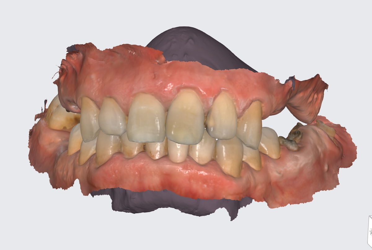 Цифровой слепок челюстей
