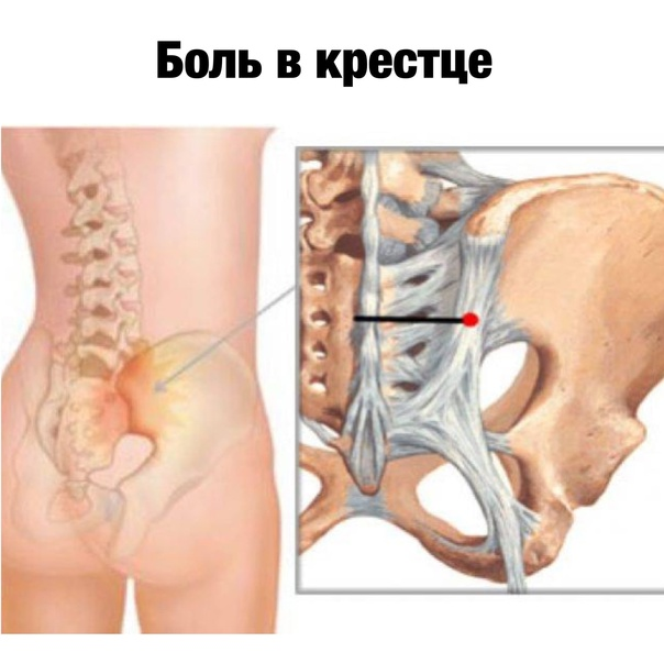 Сакроилеит: симптомы, диагностика и лечение