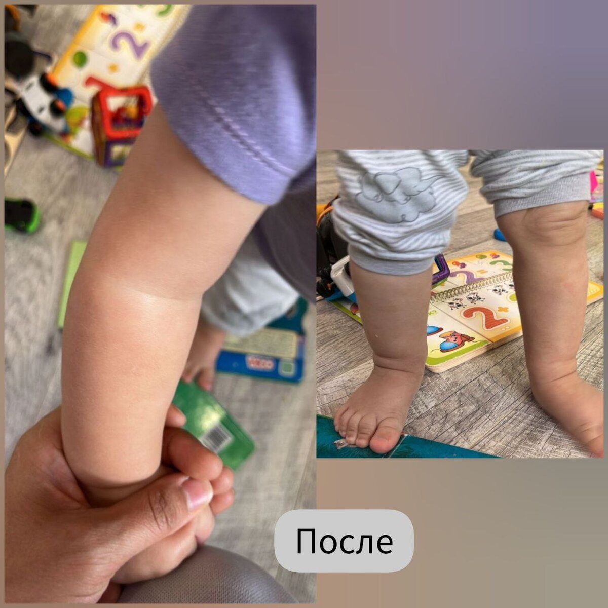 После увлажнения кремом-эмолентом от Мейсифарм