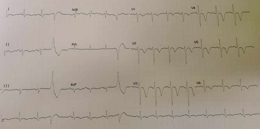 Частота сердечных сокращений 90. Две экстрасистолы на короткой ЭКГ. Подострая стадия переднего распространённого инфаркта. Скорее всего, поражена передняя межжелудочковая артерия.