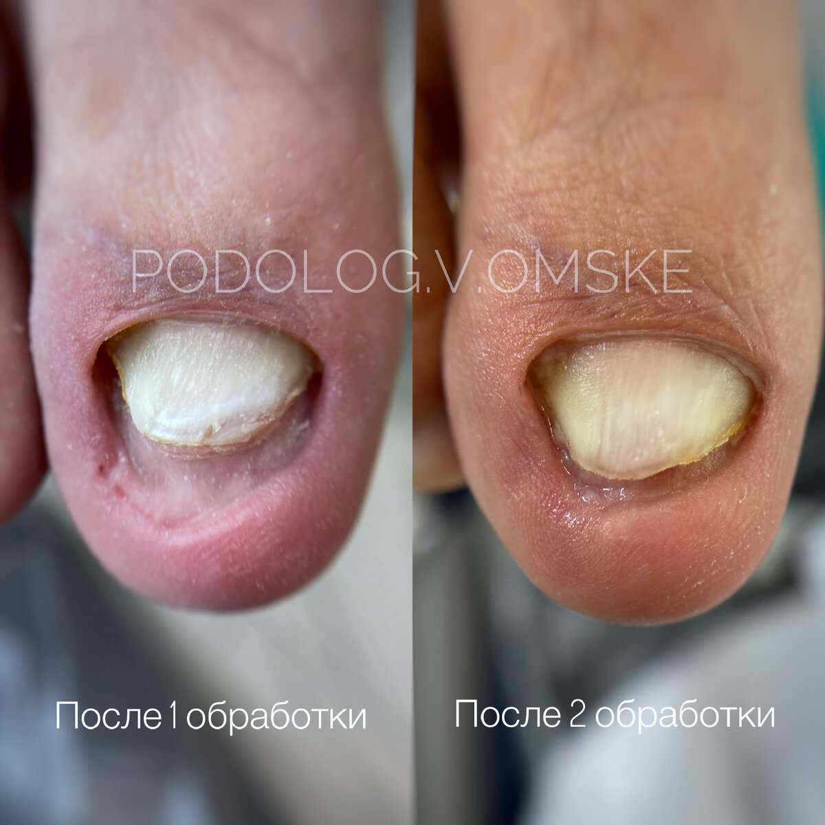 Онихогрифоз состояние обратимое 👌🏻 работаем ✅