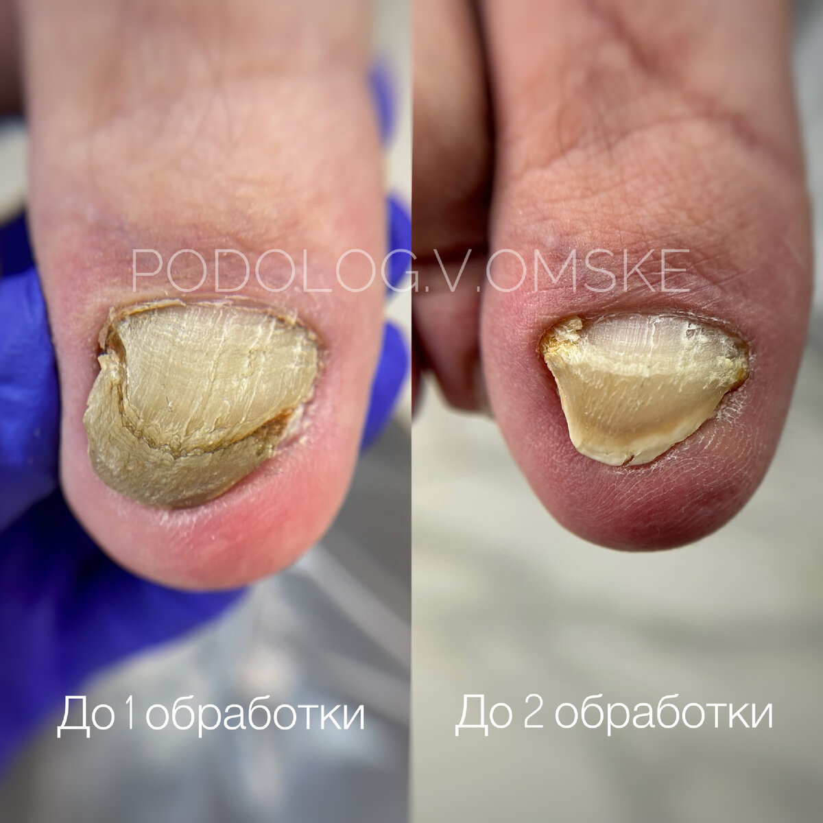 И тут нет 🍄 🙂 #Подолог #Омск 