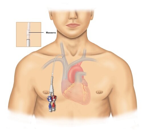 Центральный венозный катетер прокладывается под кожей. Конец катетера находится вблизи сердца. Катетер имеет один или несколько "просветов" или "разъемов", выходящих наружу через кожу. Часто под кожей располагается манжета.
