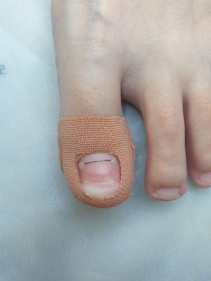 Тейпирование пальца