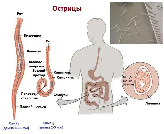 Острицы: симптомы и лечение энтеробиоза