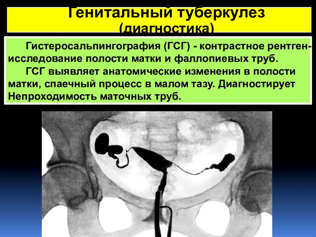 Проходим маточных труб