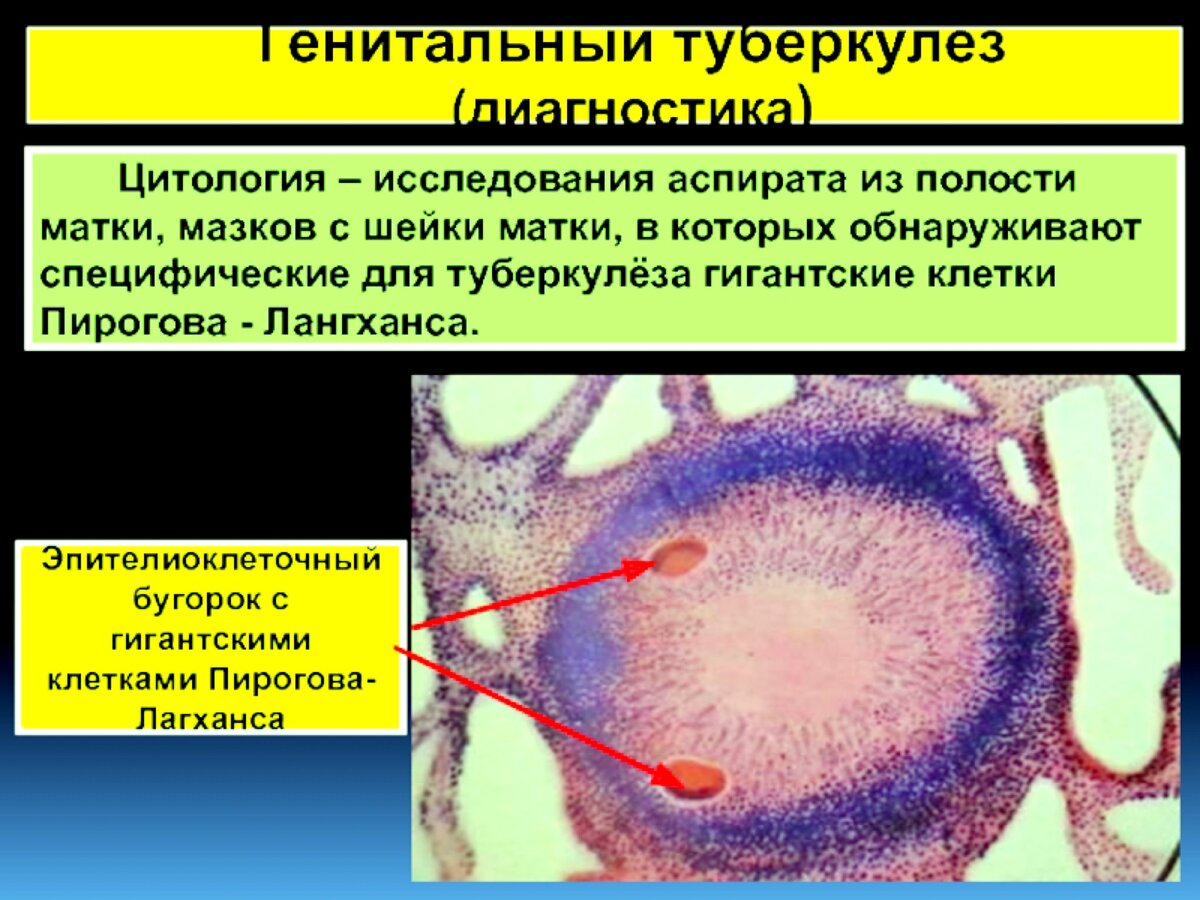 Туберкулез половых органов у женщин. Генитальный туберкулез. Туберкулез женских органов. Туберкулез женской репродуктивной системы.