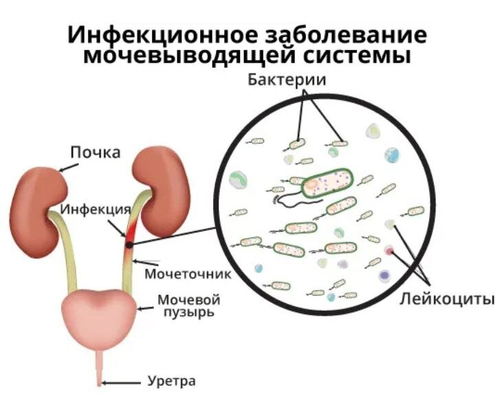 Хронический цистит моча