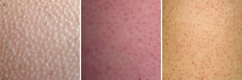 Фолликулярный кератоз. Фото взято из открытых источников.