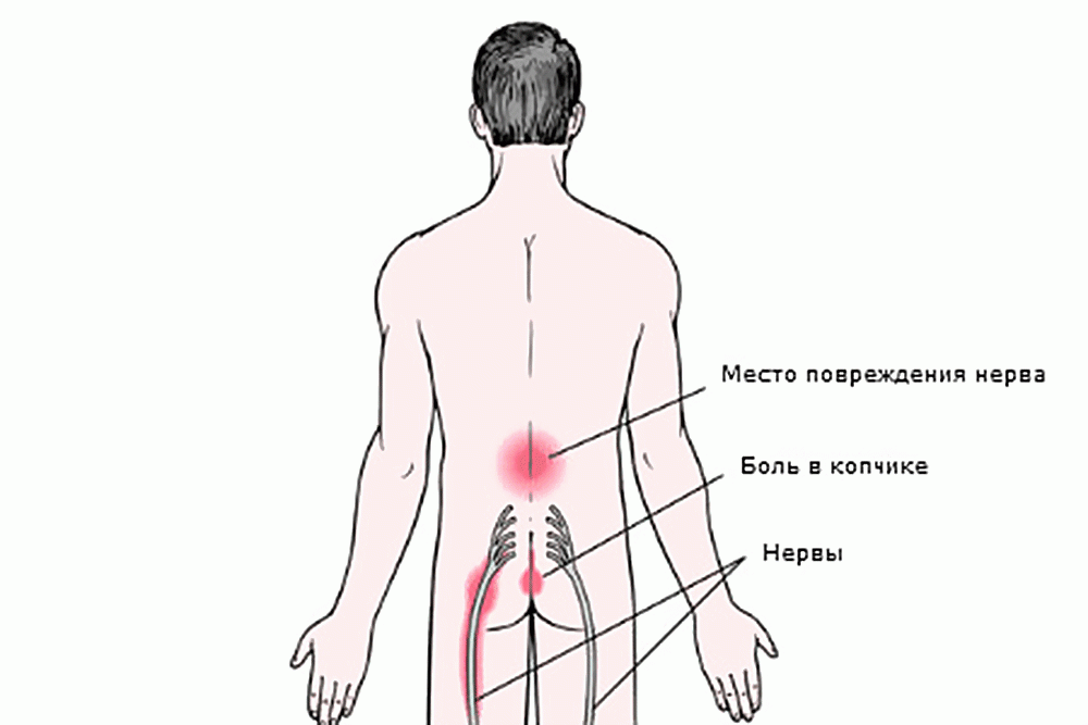 лечение боли в копчике без операции в Молдове - MedHelper