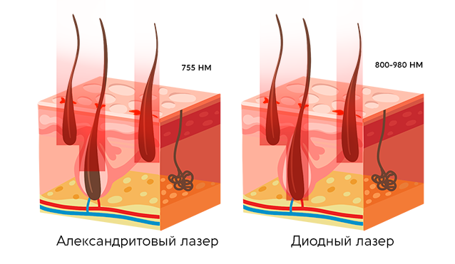 Если волосок залегает на поверхности кожи - оба лазера сработают хорошо, если волосок залегает глубоко - диод справится с ним, в отличии от своего кристального брата. 