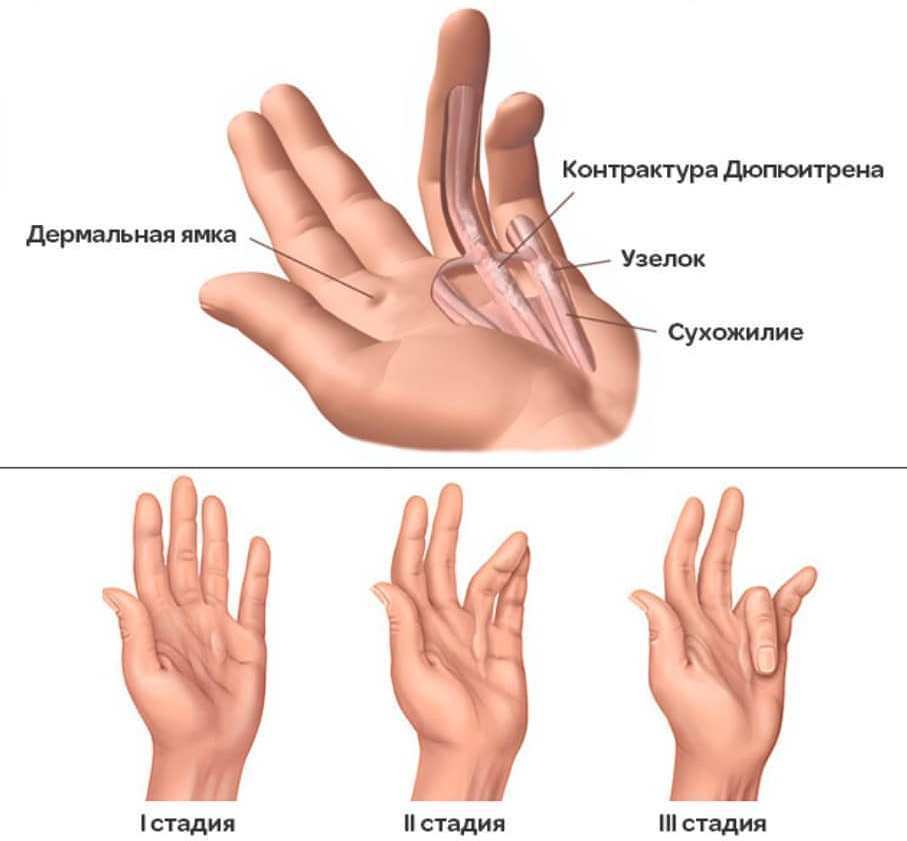 Ладонный фиброматоз (контрактура Дюпюитрена). Заболевание кисти контрактура Дюпюитрена. Стадии заболевания контрактуры Дюпюитрена. Болезнь кистей рук контрактура Дюпюитрена.