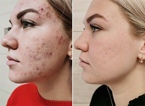 Последствия правильного ухода за кожей.