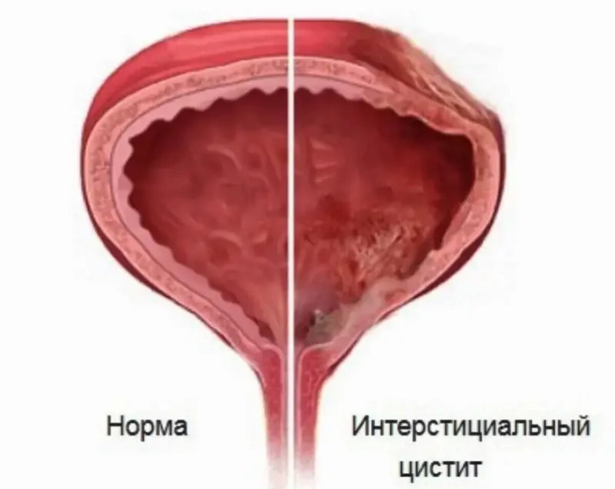 Мочевой пузырь врач лечит у женщин