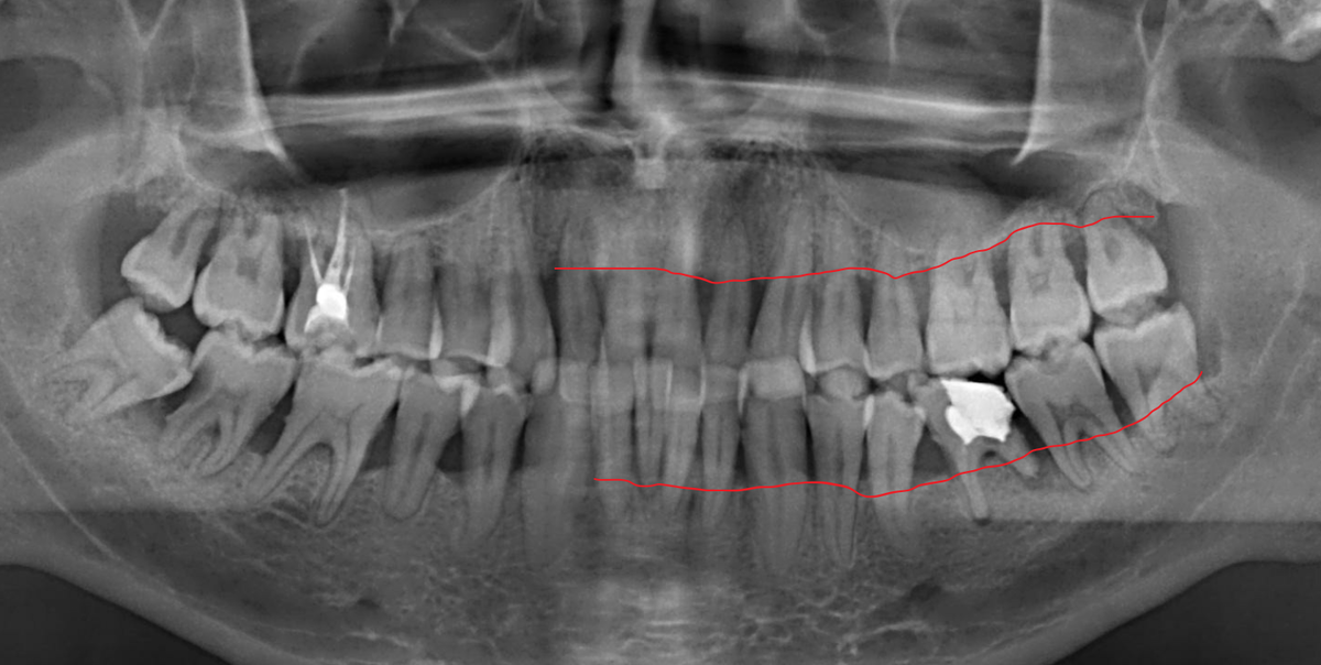 Пародонтит тяжёлой степени тяжести