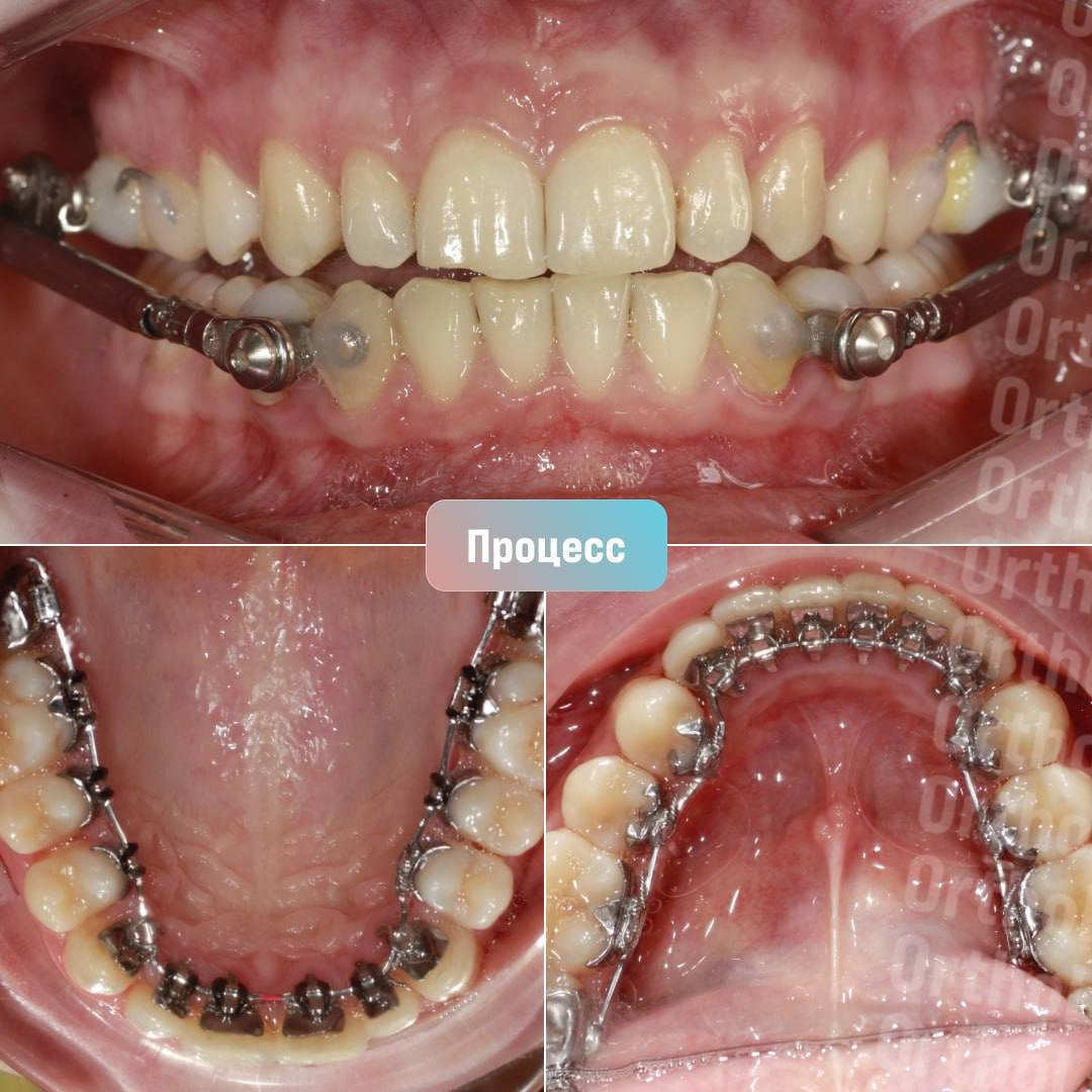 Исправление прикуса лингвальными брекетами: кейс врача-ортодонта OrthoLike  Евгении Куликовой | Андрей Жук эксперт по ортодонтии | Дзен
