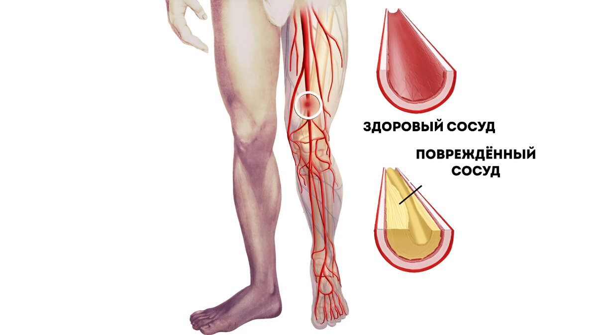 Забитые сосуды ног: 5 первых сигналов организма и что делать при их  появлении | Павел Корпачев | Дзен