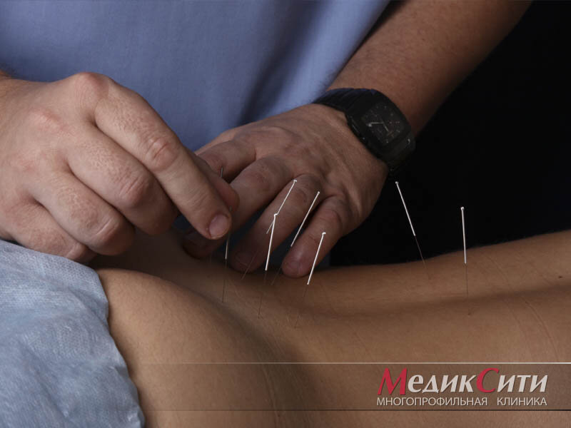Иглорефлексотерапия в "МедикСити"