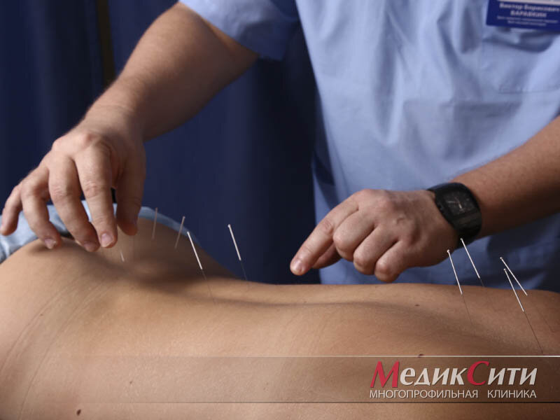 Иглорефлексотерапия в "МедикСити"