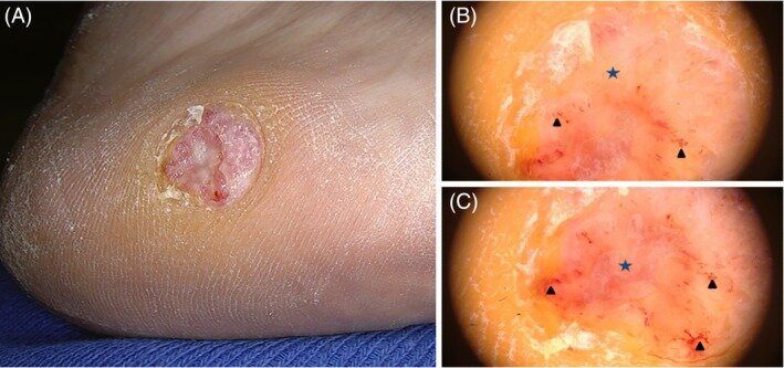 А. Макрофото: Розовато-белый узелок, с гиперкератозом по периферии и центральной эрозией. B и C. Дерматоскопические изображения: беловатые чешуйки по периферии, полиморфная модель строения сосудов (стрелки) на диффузном молочно-красном/белом бесструктурном участке (звездочки). Первоисточник - Bostan E, Dogan S, Ates Ozdemir D, Elcin G. Coexistence of amelanotic melanoma and capillary malformation on the same sole: An unusual case with dermatoscopic findings. Int Wound J. 2020 Aug;17(4):1083-1085.  
Coexistence of amelanotic melanoma and capillary malformation on the same sole: An unusual case with dermatoscopic findings - PMC (nih.gov)