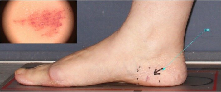 На коже медиальной поверхности правой пятки было обнаружено пятно с моделью строения в виде параллельных линий в проекции гребней и фибриллярным компонентом (во вставке). Первоисточник - Bostan E, Dogan S, Ates Ozdemir D, Elcin G. Coexistence of amelanotic melanoma and capillary malformation on the same sole: An unusual case with dermatoscopic findings. Int Wound J. 2020 Aug;17(4):1083-1085.  
Coexistence of amelanotic melanoma and capillary malformation on the same sole: An unusual case with dermatoscopic findings - PMC (nih.gov)