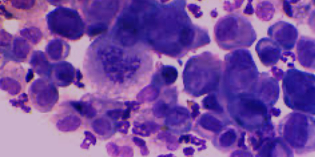 Как разобраться в результатах онкоцитологии?