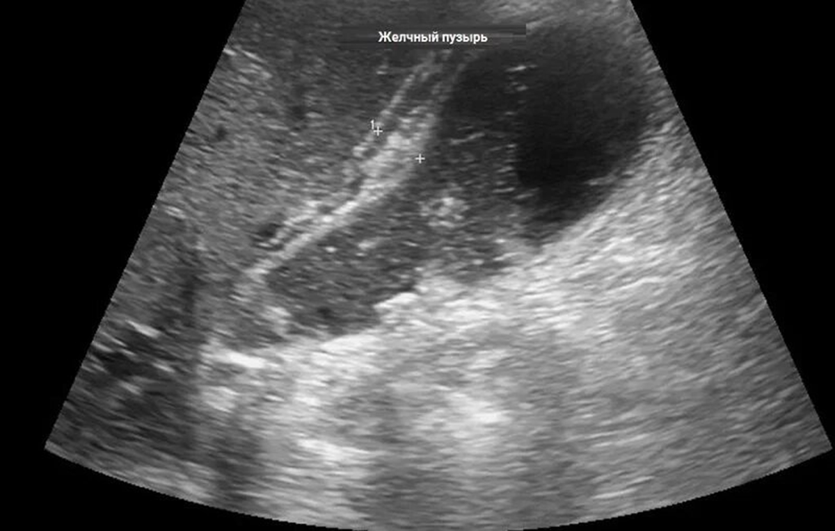 Эхопризнаки холецистита. Острый калькулезный холецистит УЗИ. Флегмонозный холецистит УЗИ. УЗИ желчного пузыря острый холецистит. Калькулезный холецистит УЗИ.