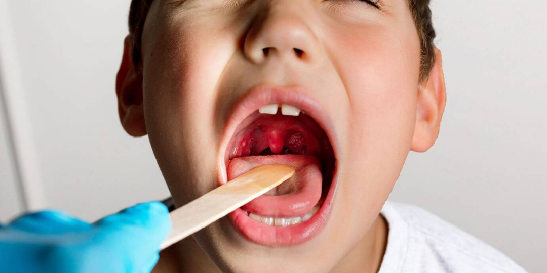 Ангина у детей: как лечить острый тонзиллит в разном возрасте?