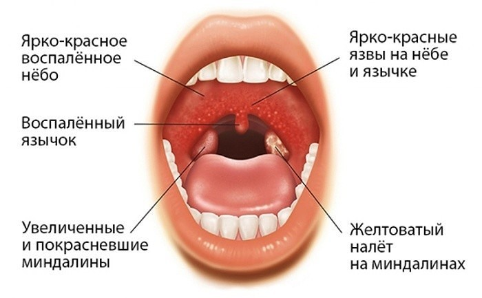 Ангина у детей: лечение в домашних условиях и основные симптомы