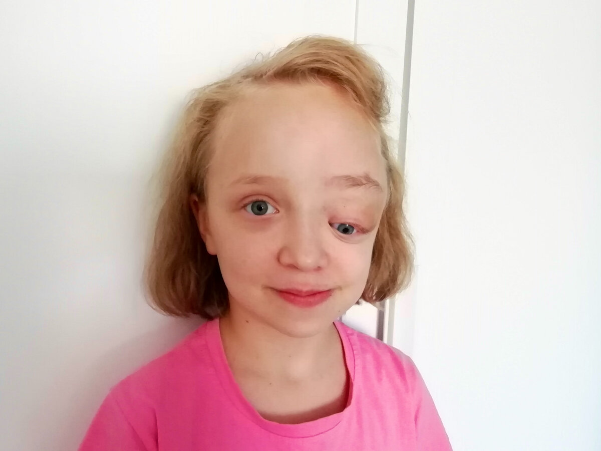 Когда Ульяна родилась, ее левый глаз был немного больше, чем правый. Родители забеспокоились, обратились к врачу. Ребенку поставили диагноз: глаукома. Малышку лечили у офтальмолога.