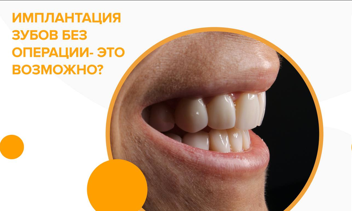 Можно ли вставить имплантат без операции? Такая методика действительно существует, и уже давно активно применяется на практике в российских стоматологиях. 

Как это?