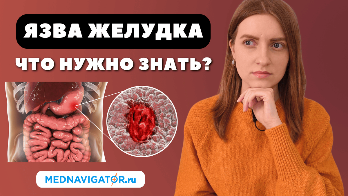 ЯЗВА ЖЕЛУДКА - причины, симптомы, диагностика, лечение и профилактика |  Mednavigator.ru | Дзен