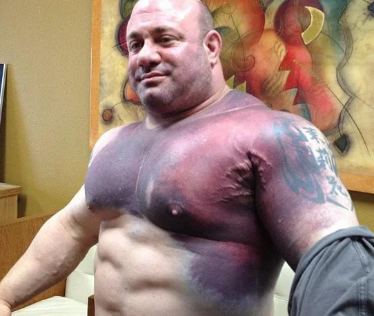 Известнейшее фото Мендельсона после того, как он порвал грудную мышцу при попытке установить мировой рекорд в жиме лежа