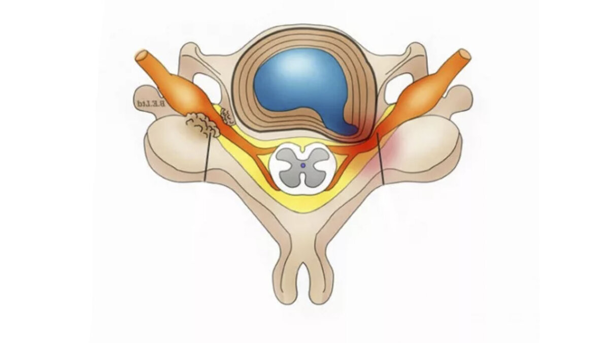 Фораминальная грыжа диска – особенности и терапия | Клиника Бобыря | Дзен