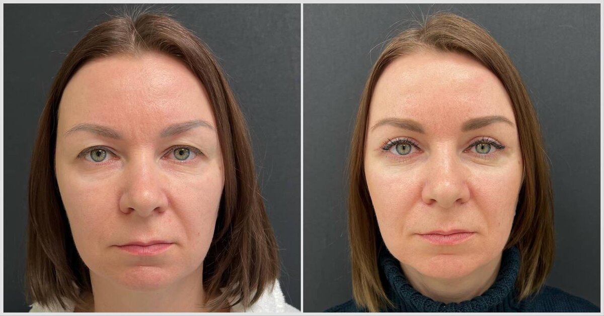 erid:LjN8JvaWF 2 недели после верхней блефаропластики. Через несколько месяцев рубцы побелеют и станут незаметными. Пластический хирург Зинин Виталий Юрьевич.