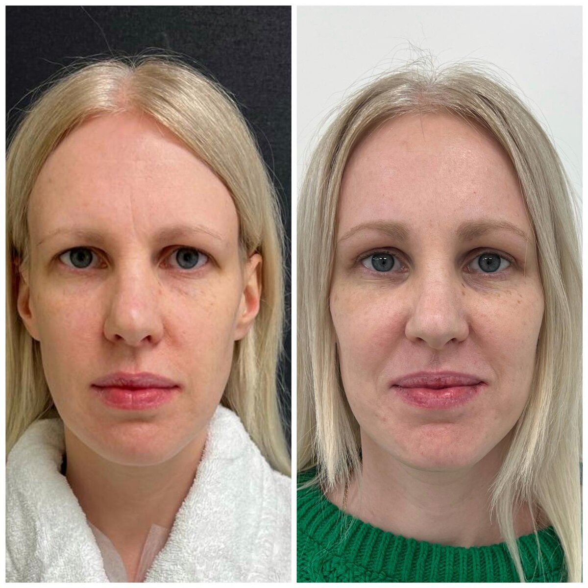 Выполнена деликатнейшая блефаропластика верхних век и эндоскопический лобный лифтинг. Также проведена трансконьюнктивальная блефаропластика, удалили грыжи, которые по утрам либо после погрешностей в еде беспокоили девушку. Также провели липофилинг подглазничной, скуловой и височной области, что придало лицу свежести и несколько изменило пропорции лица. Без доброго лифтинга блефаропластика была бы бесполезна ввиду индивидуальных анатомических особенностей пациентки. Пластический хирург Зинин Виталий Юрьевич.