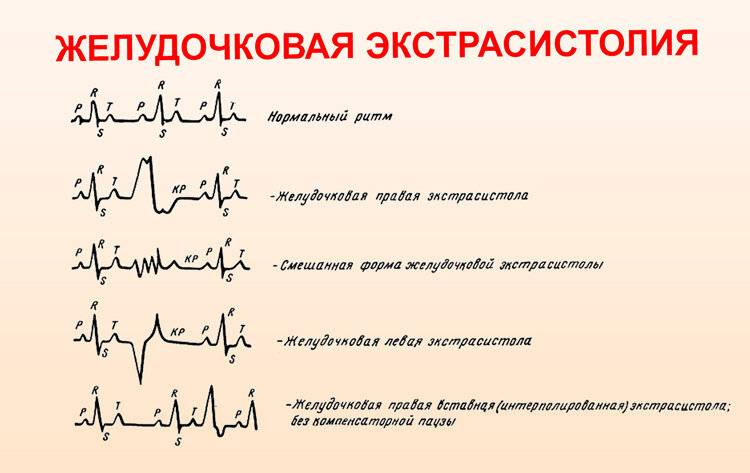 Как быстро снять экстрасистолию Почему у меня возникает экстрасистолия: причины аритмии и как это устранить? О з