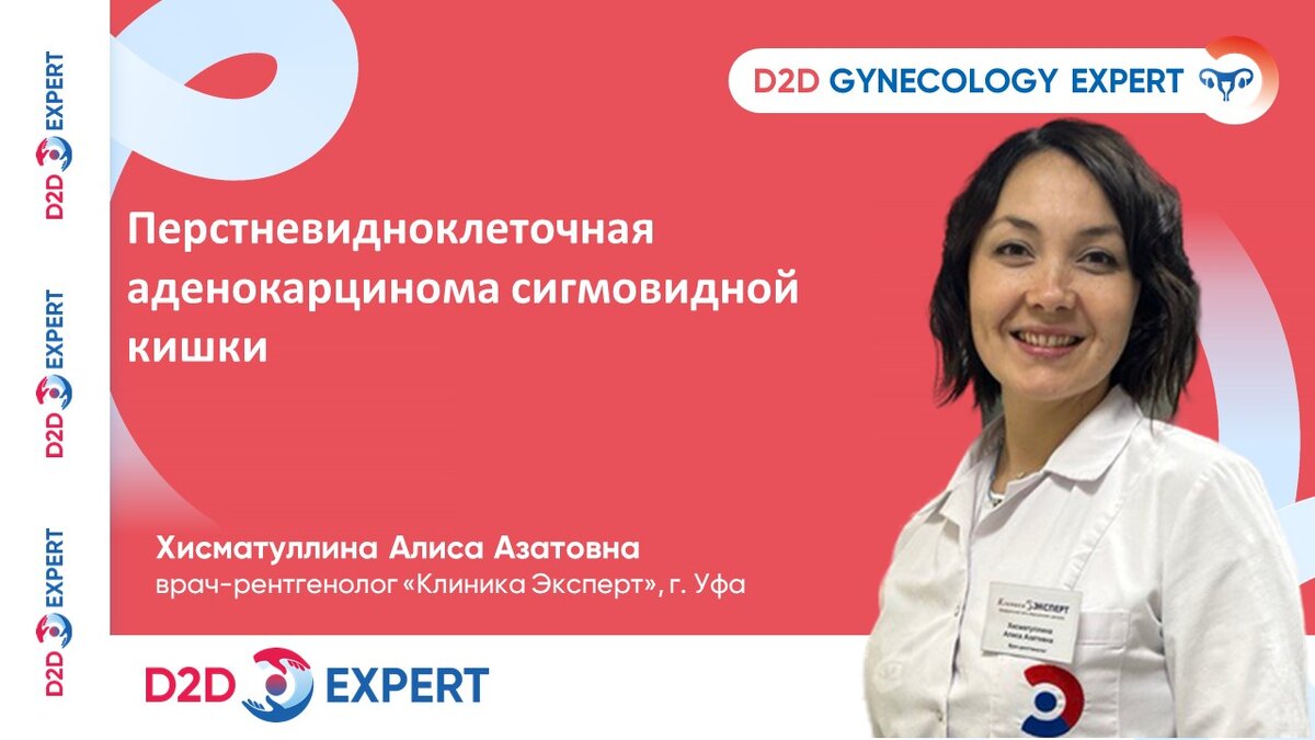 Перстневидноклеточная аденокарцинома сигмовидной кишки. | D2D Expert | Дзен