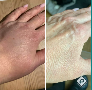 Реальный пример из жизни, как Deep Blue dōTERRA убирает отек при сильном ушибе