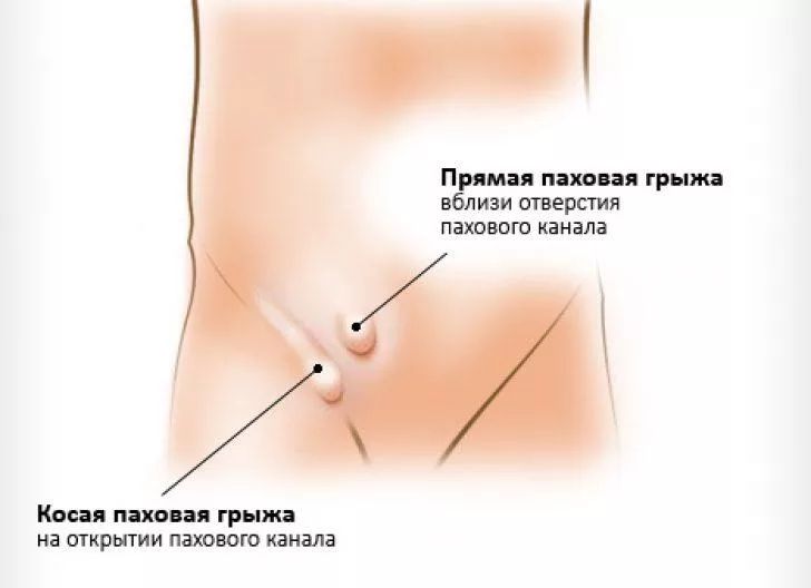 Паховая грыжа у мужчин фото последствия