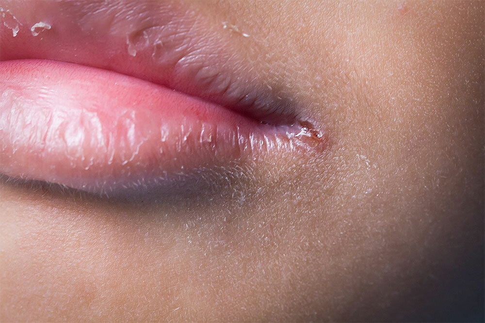 У ребенка опухла нижняя губа. Гиповитаминозный хейлит. Гиповитаминозный хейлит. Ангулярный хейлит кандидоз. Простудный герпес на губах.